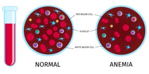 blood_cells_anemia